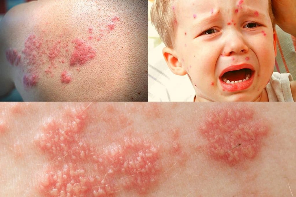 Disseminted Herpes Zoster And Shingles-min